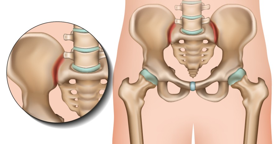 Pelvic-Girdle-Pain